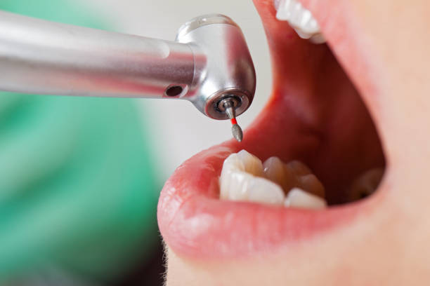 Best Emergency Root Canal Treatment in North Madison, OH